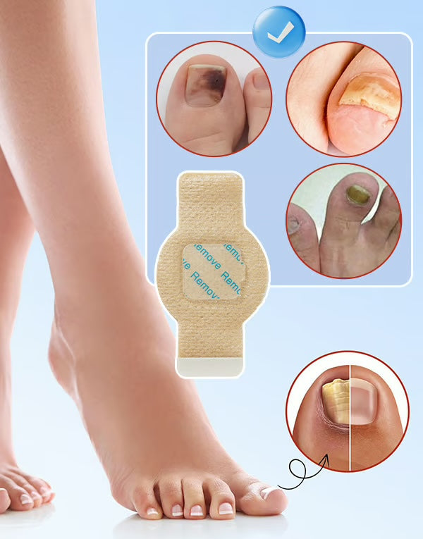 MycoPatch™ - Svampdödande nagelklistermärken