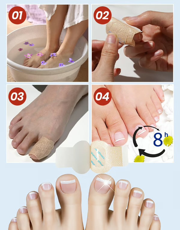 MycoPatch™ - Svampdödande nagelklistermärken