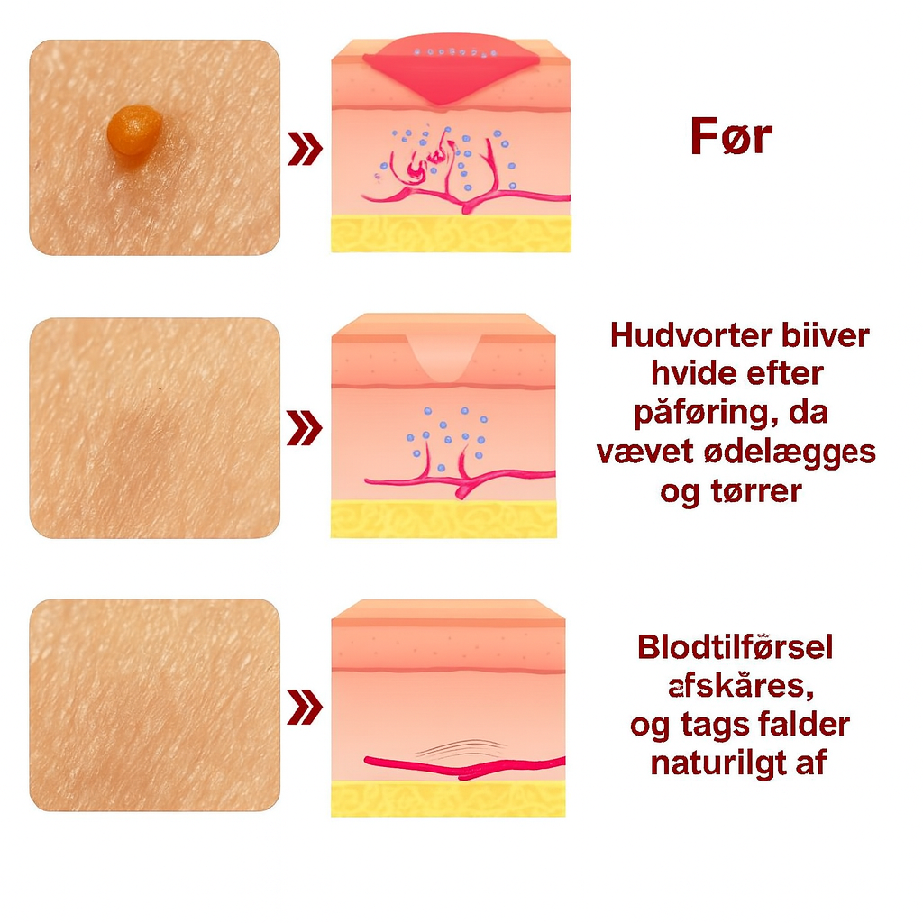 DermaCure™ | Tar bort vårtor och åldersfläckar – smärtfritt inom 3 dagar!