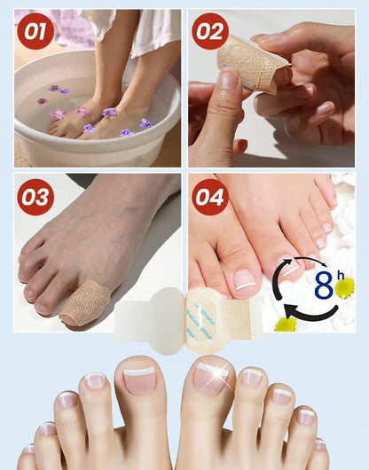 MycoPatch™ - Svampdödande nagelklistermärken